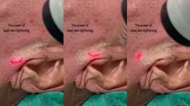 Laserové zpevnění kůže